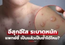 “อีสุกอีใส” กำลังระบาด หลังพบคลัสเตอร์หลักหมื่น แพทย์เฉลย คนเป็นแล้วเป็นซ้ำได้หรือไม่?