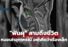 อุทาหรณ์! ชาย “ฟันผุ” ไม่รักษา ลามป่วยหนัก ผุดฝีหลังคอ-ติดเชื้อไขสันหลัง สุดท้ายดับ
