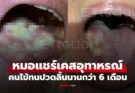 คนไข้ใจแข็งทนปวดลิ้น 6 เดือน แค่เดินเข้ามาหมอใจเสีย ได้กลิ่นที่ไม่มีใครอยากเจอ