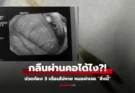 เกือบจัดงานศพ หนุ่มปวดท้องเป็นเดือนๆ ไม่หาย หมอผ่า “สิ่งนี้” ออกมา ตาตื่นทั้งครอบครัว!