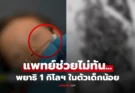เกิดอะไรขึ้น? ไวรัลช็อก พยาธิโผล่รูจมูกเด็ก 4 ขวบ ขับออกมาเกิน 1 กิโล หมอสุดยื้อชีวิต