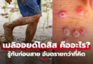 “เมลิออยด์โดสิส” คืออะไร? อาการคล้ายหวัด แต่อันตรายกว่าที่คิด พบดับแล้ว 23 ราย
