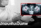 อุทาหรณ์ เด็กอายุแค่ 17 เสียชีวิตเพราะ “ถอนฟันคุด” ตร.เจอสาเหตุช็อก ตายทั้งที่ไม่ควรตาย!