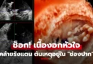 สะพรึง! ก้อนเนื้อคล้าย” รังแตน” กินหัวใจชายวัย 51 ลามสมอง-ไต หวิดดับ ก่อนพบต้นเหตุจาก “ในช่องปาก”