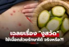 เฉลยแล้ว “งูสวัด” ขึ้นรอบเอวแล้วต้องตาย? แต่ใช้เนื้อกล้วยรักษาได้ จริงหรือ?!