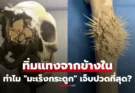 สะพรึง! ทำไมมะเร็งกระดูกถึงเจ็บปวดที่สุด? เปิดภาพก้อนเนื้อร้ายที่ทิ่มแทงจากข้างใน